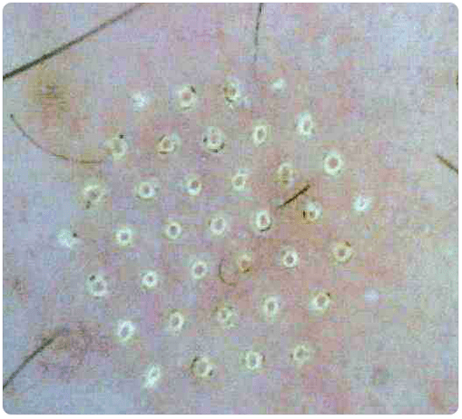 piel bajo un microscopio después del rejuvenecimiento fraccional