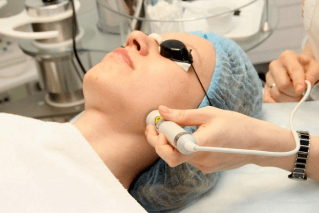 Biorevitalización láser