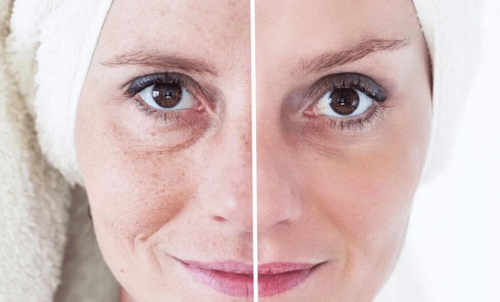 rejuvenecimiento facial con láser